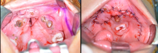 Palatal-Fistula-Closure