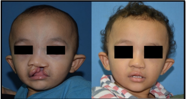 cleft-lip-surgery