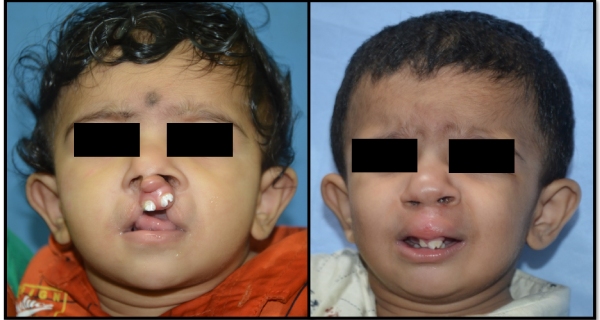 cleft-lip-surgery