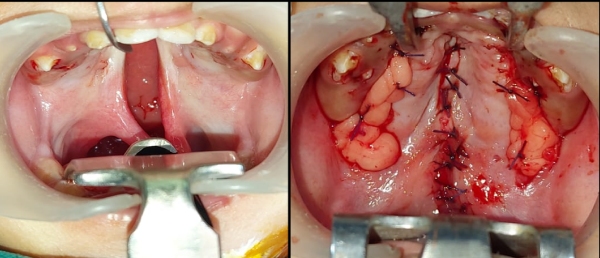 cleft-palate-surgery