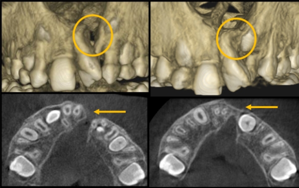 Cleft-Alveolus-Surgery