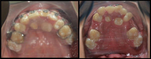 Anterior-Maxillary-Distraction