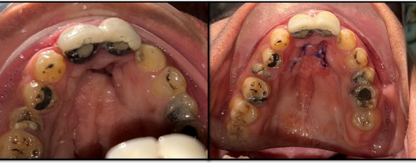 Palatal-Fistula-Closure