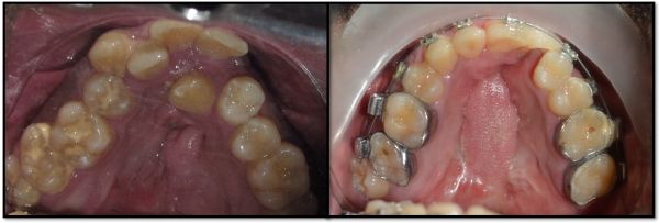 Palatal-Fistula-Closure