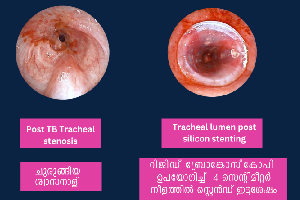 New Life for Mumbai Resident with Narrowed Windpipe 
